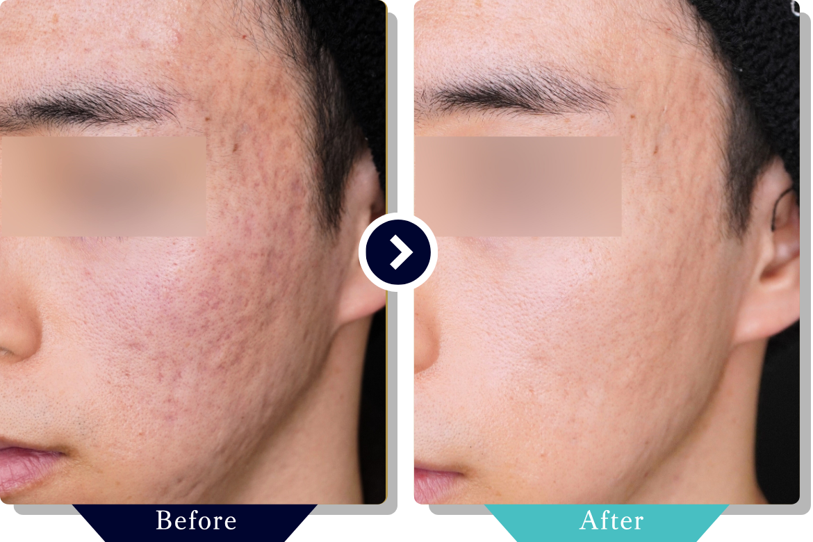 サブシジョン | ニキビ・ニキビ跡