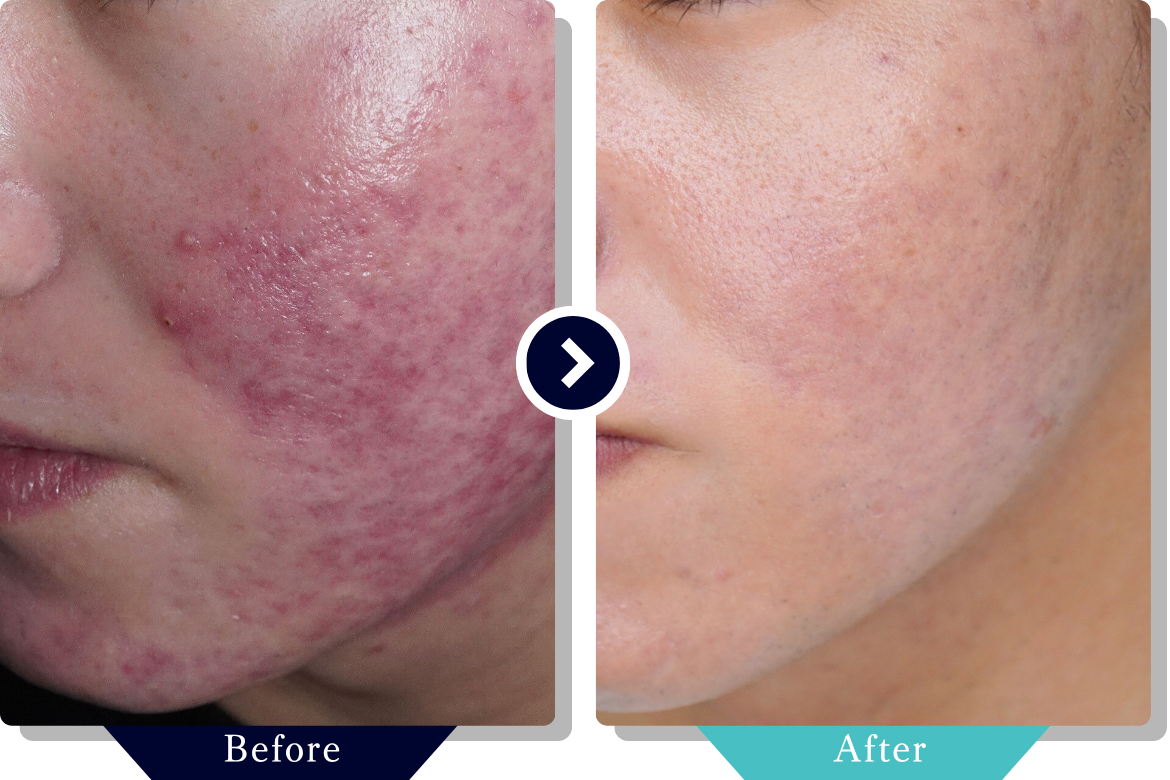 サブシジョン | ニキビ・ニキビ跡