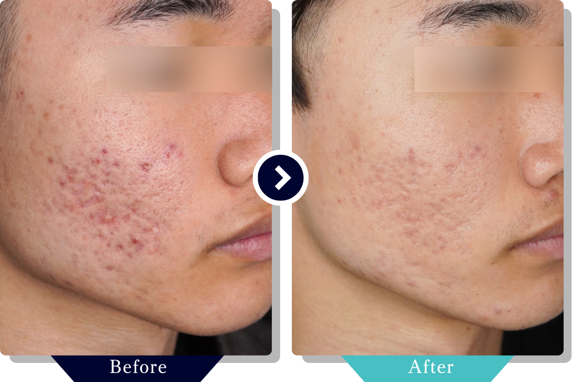 サブシジョン | ニキビ・ニキビ跡