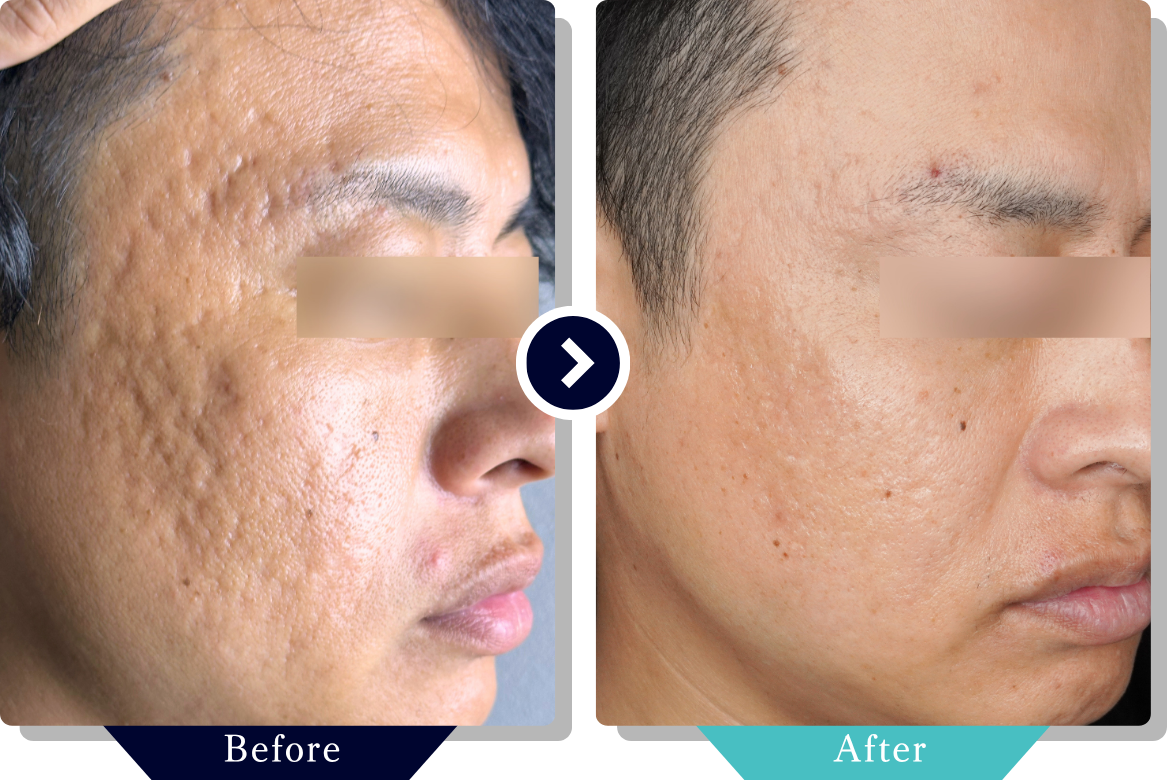 サブシジョン | ニキビ・ニキビ跡