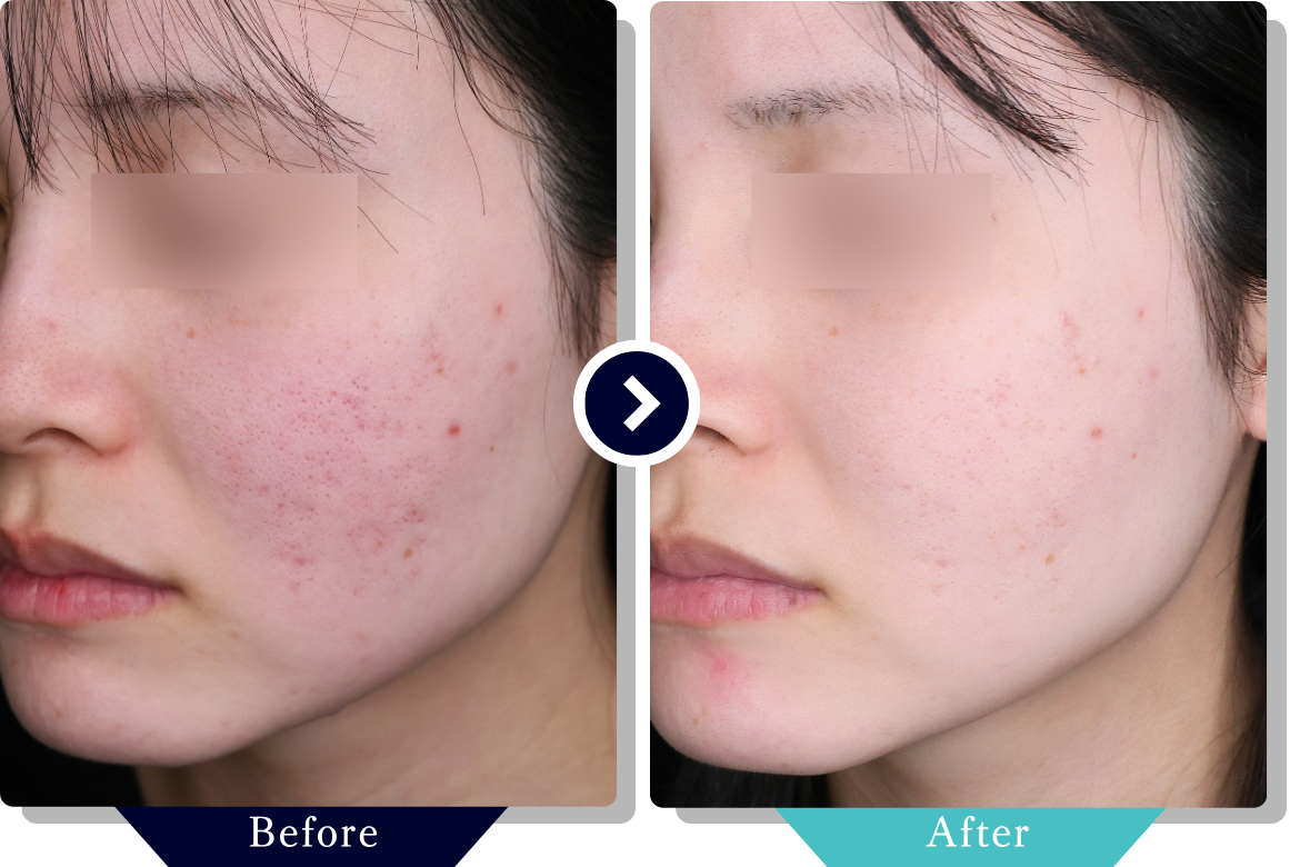 サブシジョン | ニキビ・ニキビ跡