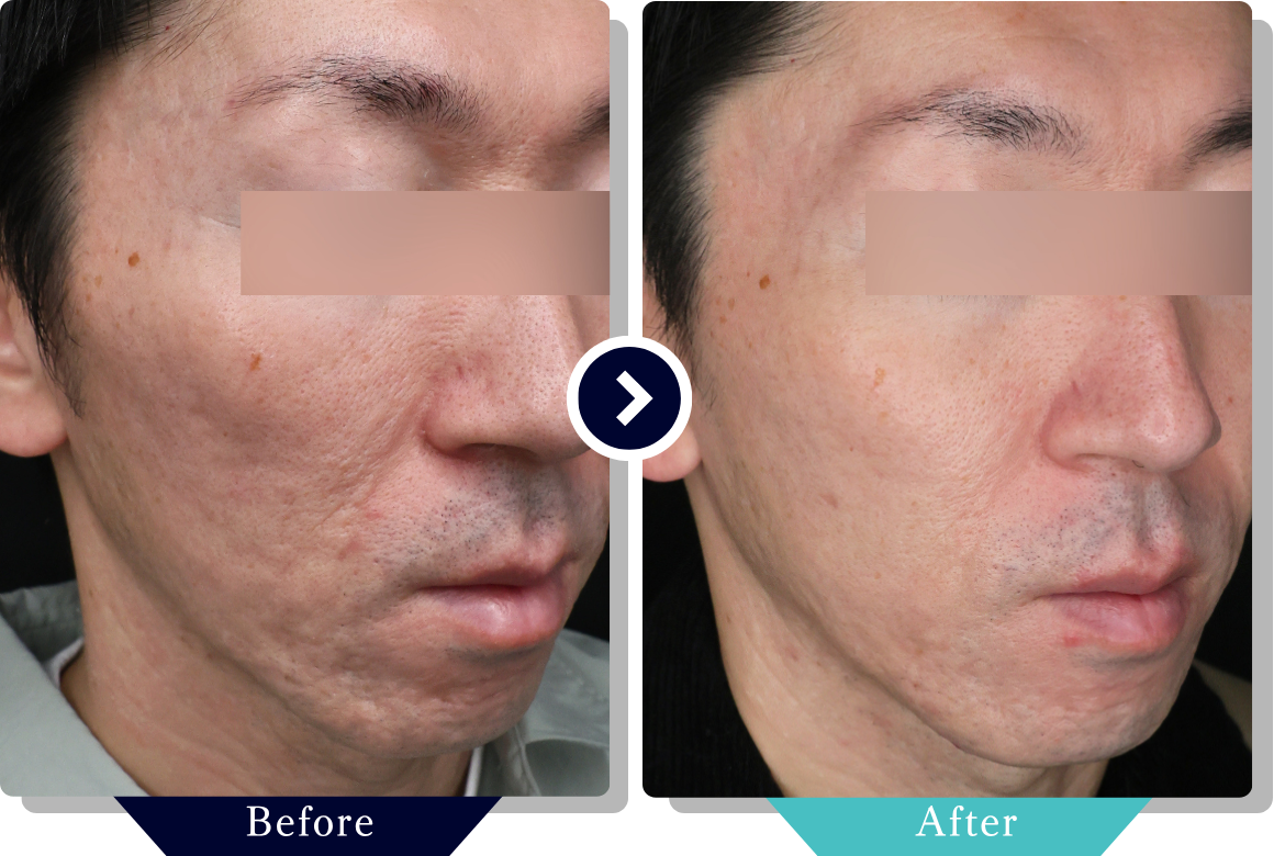 サブシジョン | ニキビ・ニキビ跡