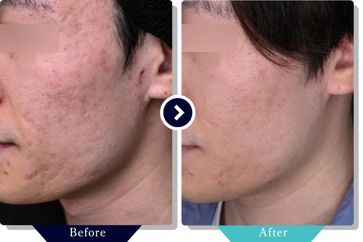 サブシジョン | ニキビ・ニキビ跡