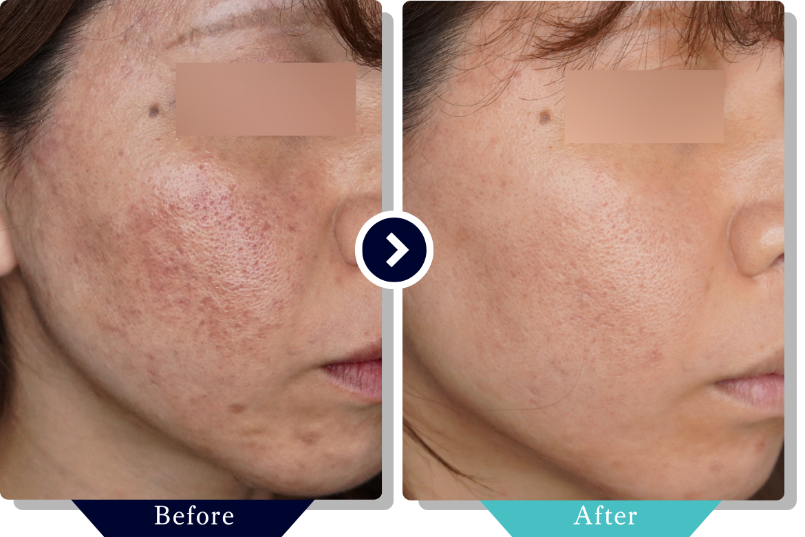 サブシジョン | ニキビ・ニキビ跡