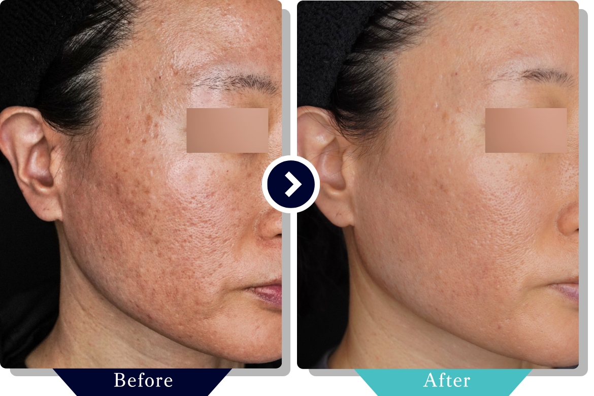 サブシジョン | ニキビ・ニキビ跡