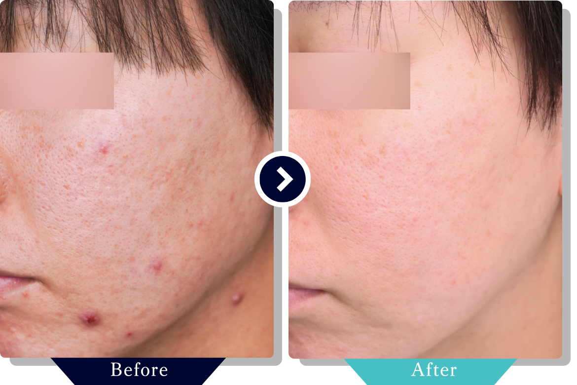 サブシジョン | ニキビ・ニキビ跡