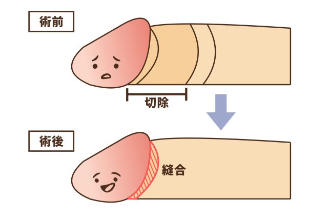 イチビ式包茎術 | 男性器形成