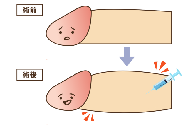 亀頭・陰茎ヒアルロン酸注入 | 男性器形成