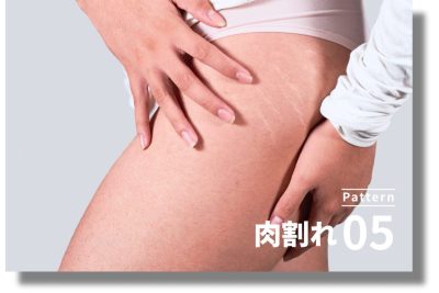 キュアジェット | ニキビ・ニキビ跡