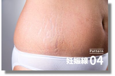 キュアジェット | ニキビ・ニキビ跡