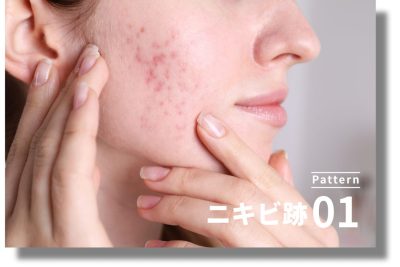 キュアジェット | ニキビ・ニキビ跡