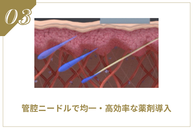 ブレッシング | たるみ・リフトアップ
