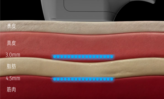 オーダーメイドHIFU（10トリプル） | たるみ・リフトアップ