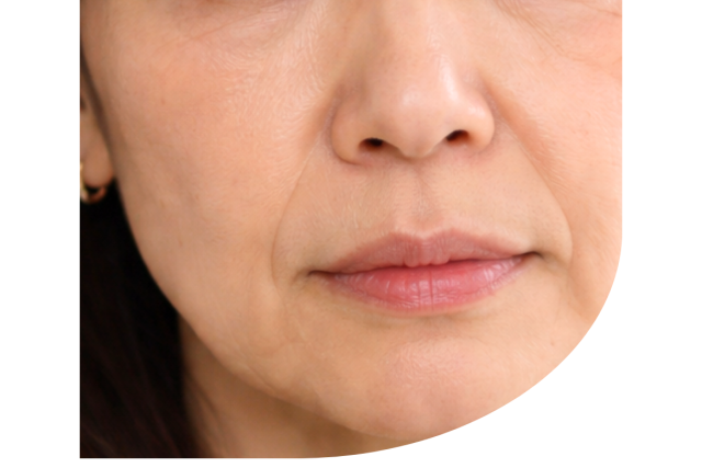 中顔面短縮３Dチークリフト(バーティカルリフト) | たるみ・リフトアップ