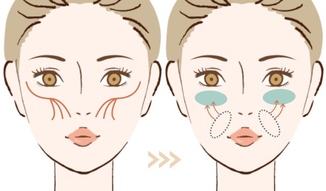 坂東式糸リフト | たるみ・リフトアップ