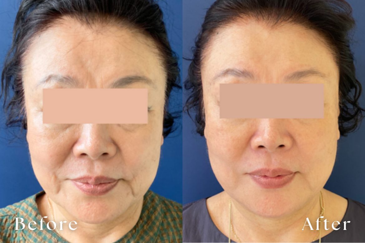 テンサーマ（10THERMA） | たるみ・リフトアップ