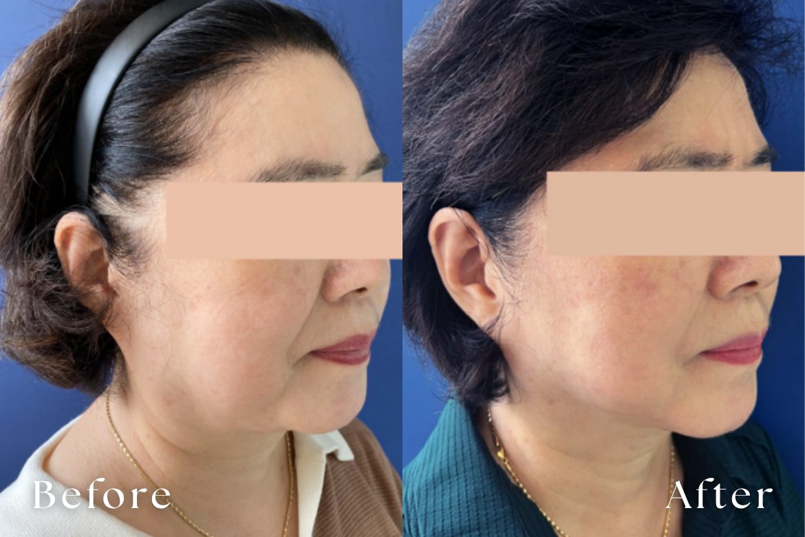 テンサーマ（10THERMA） | たるみ・リフトアップ