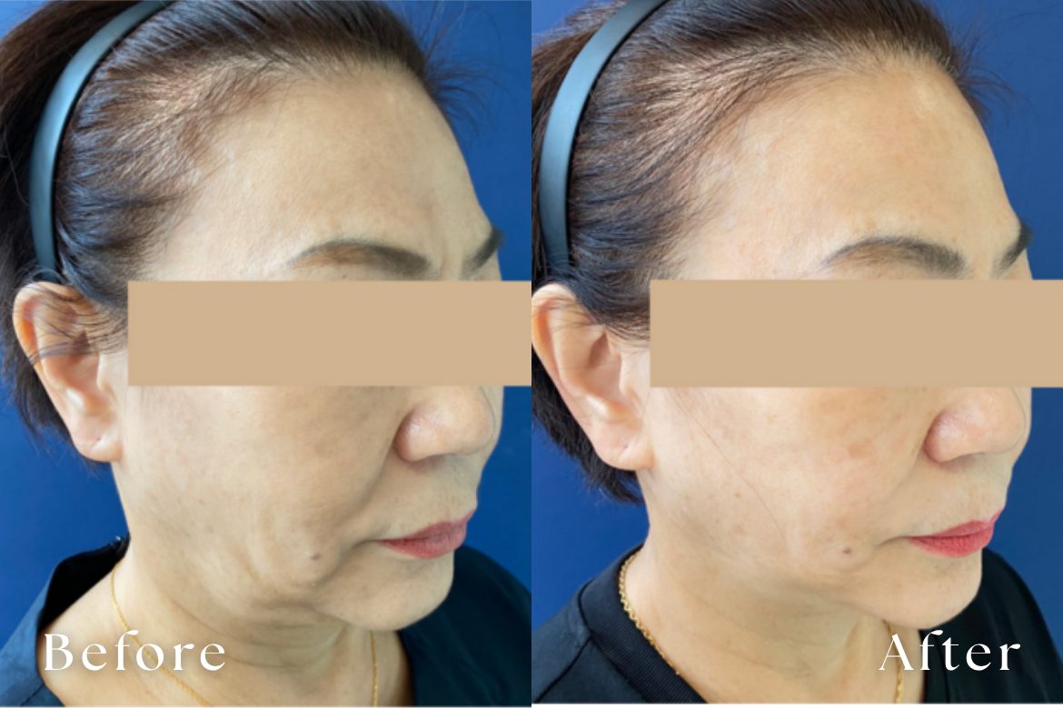 テンサーマ（10THERMA） | たるみ・リフトアップ