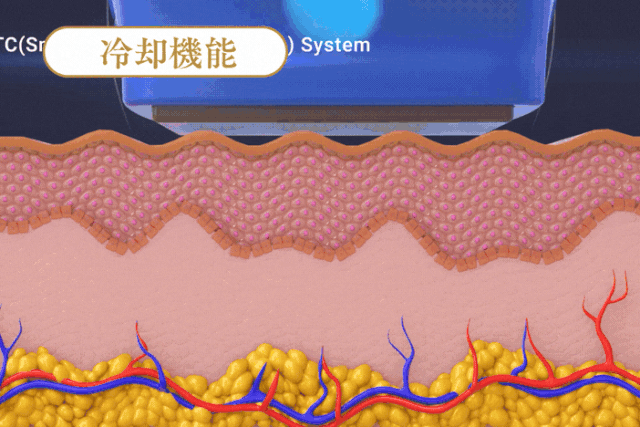 テンサーマ（10THERMA） | たるみ・リフトアップ